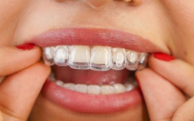 Why Adults and Teens Love Spark Clear Aligners in Clearwater