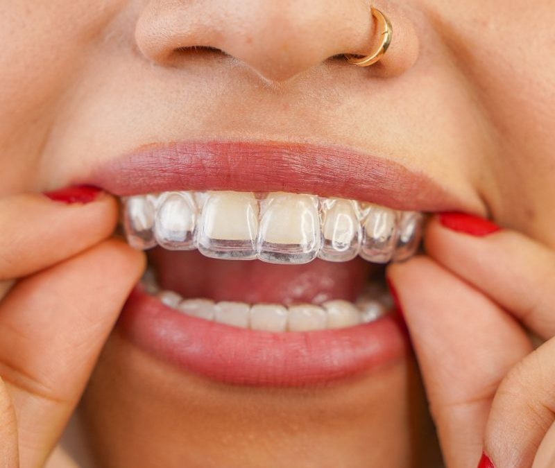 Why Adults and Teens Love Spark Clear Aligners in Clearwater
