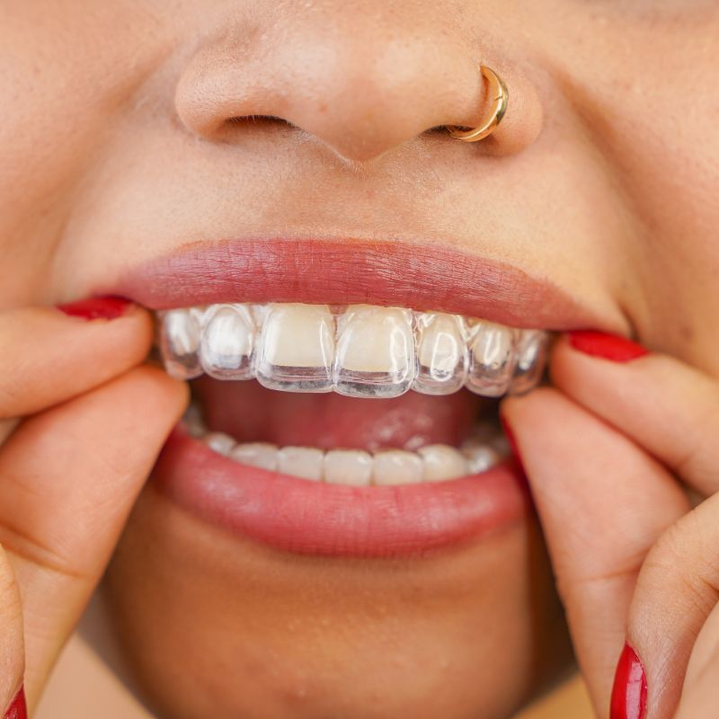 Spark clear aligners in Clearwater Spark clear aligners in Clearwater