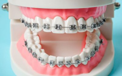 Braces for Teeth in Clearwater: Modern Options for Kids, Teens, and Adults