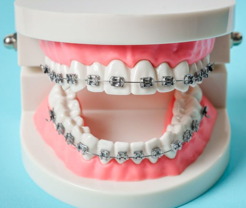 Braces for Teeth in Clearwater: Modern Options for Kids, Teens, and Adults