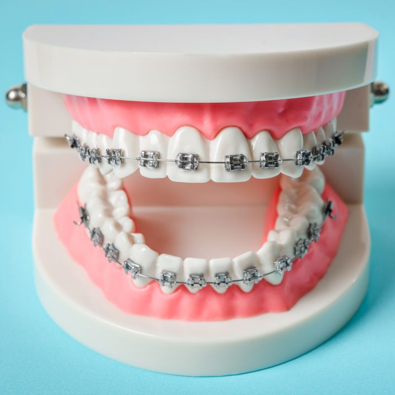 braces for teeth in Clearwater braces for teeth in Clearwater