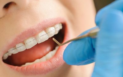 Affordable Ceramic Braces in Clearwater Florida for Every Family