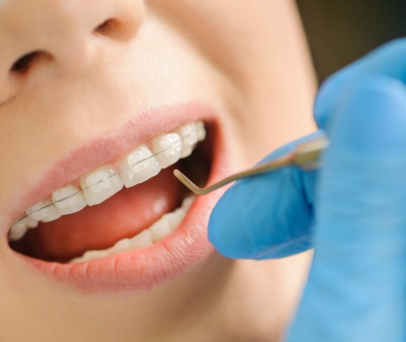 Affordable Ceramic Braces in Clearwater Florida for Every Family