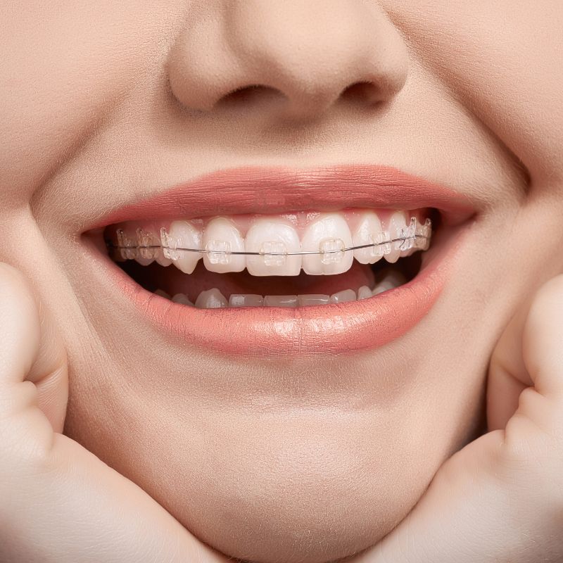 ceramic braces near me