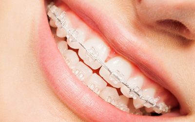 Clear Braces in Clearwater: Transforming Smiles with Comfort and Style