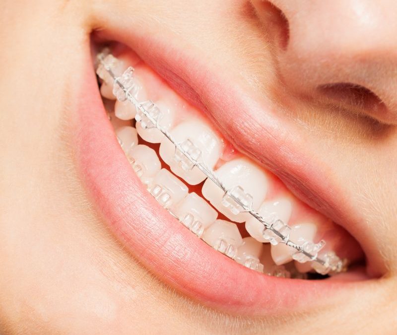 Clear Braces in Clearwater: Transforming Smiles with Comfort and Style