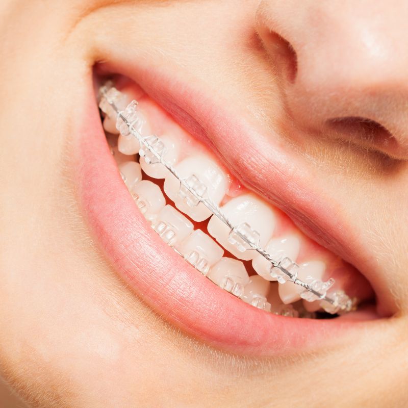 clear braces in Clearwater clear braces in Clearwater