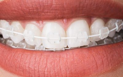 Invisible Braces in Clearwater: How Adults and Teens Can Benefit