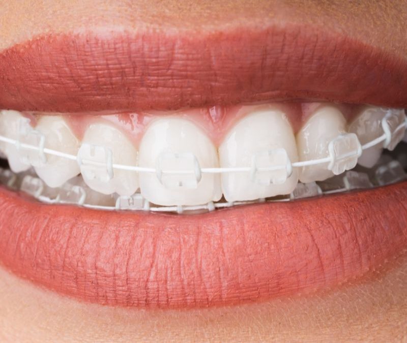 Invisible Braces in Clearwater: How Adults and Teens Can Benefit