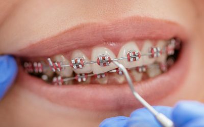 Straighten Teeth in Clearwater FL with Affordable Financing Options