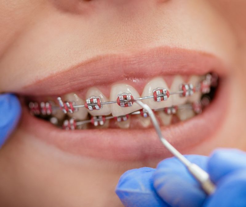 Straighten Teeth in Clearwater FL with Affordable Financing Options