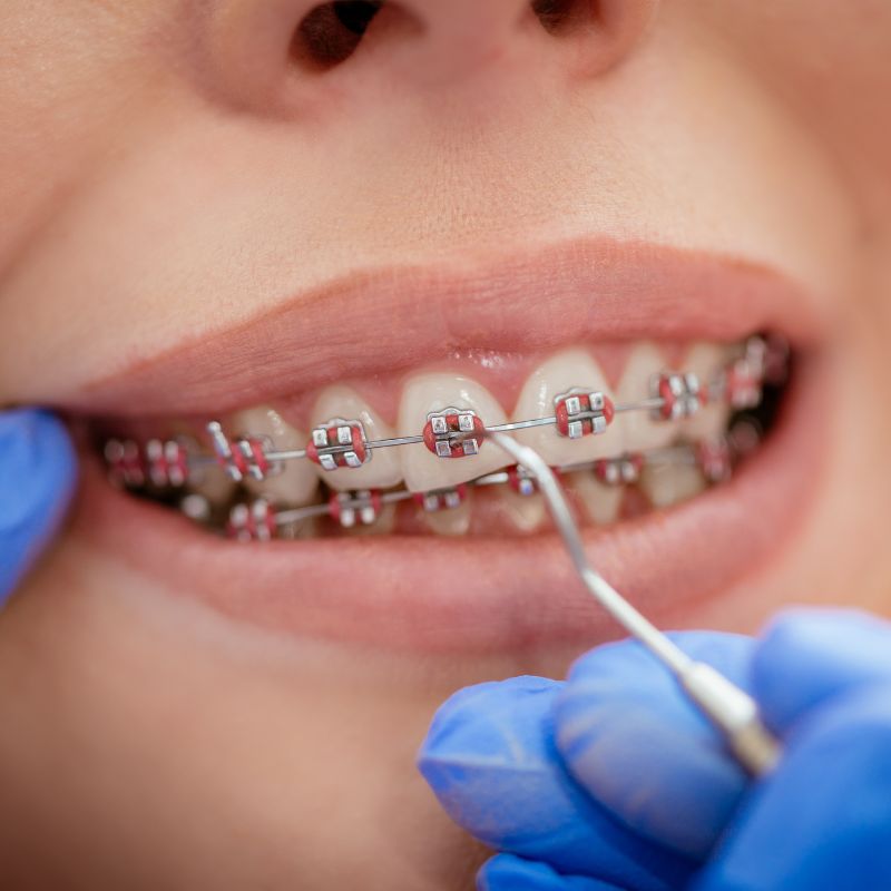 straighten teeth in Clearwater FL straighten teeth in Clearwater FL