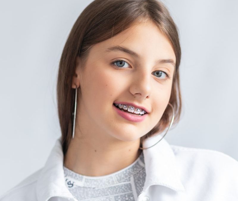 Where to Get Braces in Clearwater: Affordable Options for Every Budget