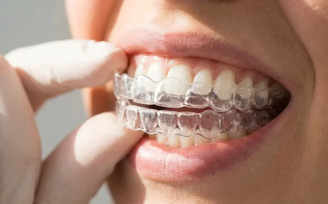 What Are Transparent Teeth Braces and How Do They Work?