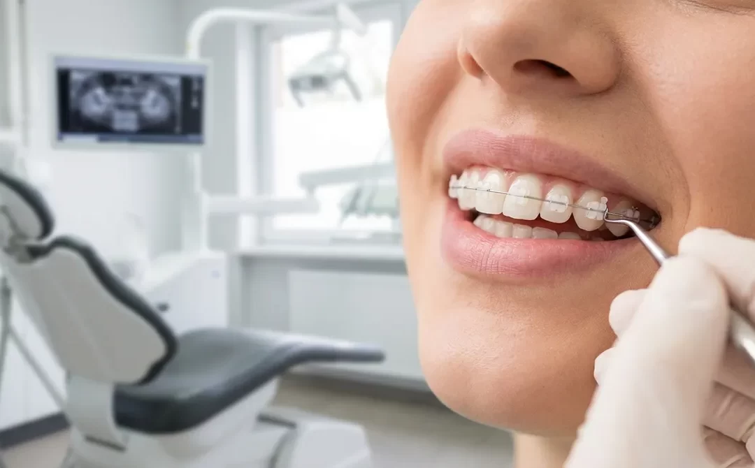 How to Choose the Right Braces for Your Adult Smile