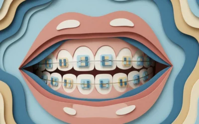 How to Choose the Right Braces as a Young Adult in 2026