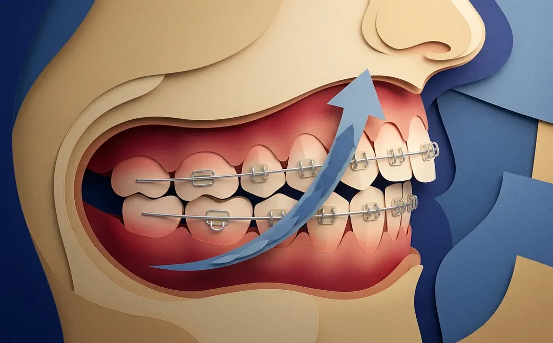 How Do Braces Fix a Deep Overbite?