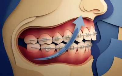 How Do Braces Fix a Deep Overbite?