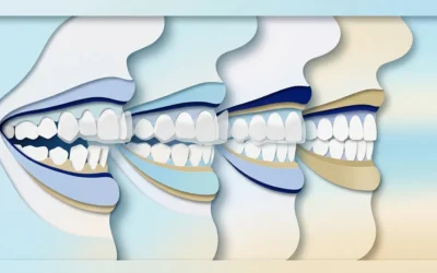 Clear Aligners Clearwater Florida: Straighten Your Smile