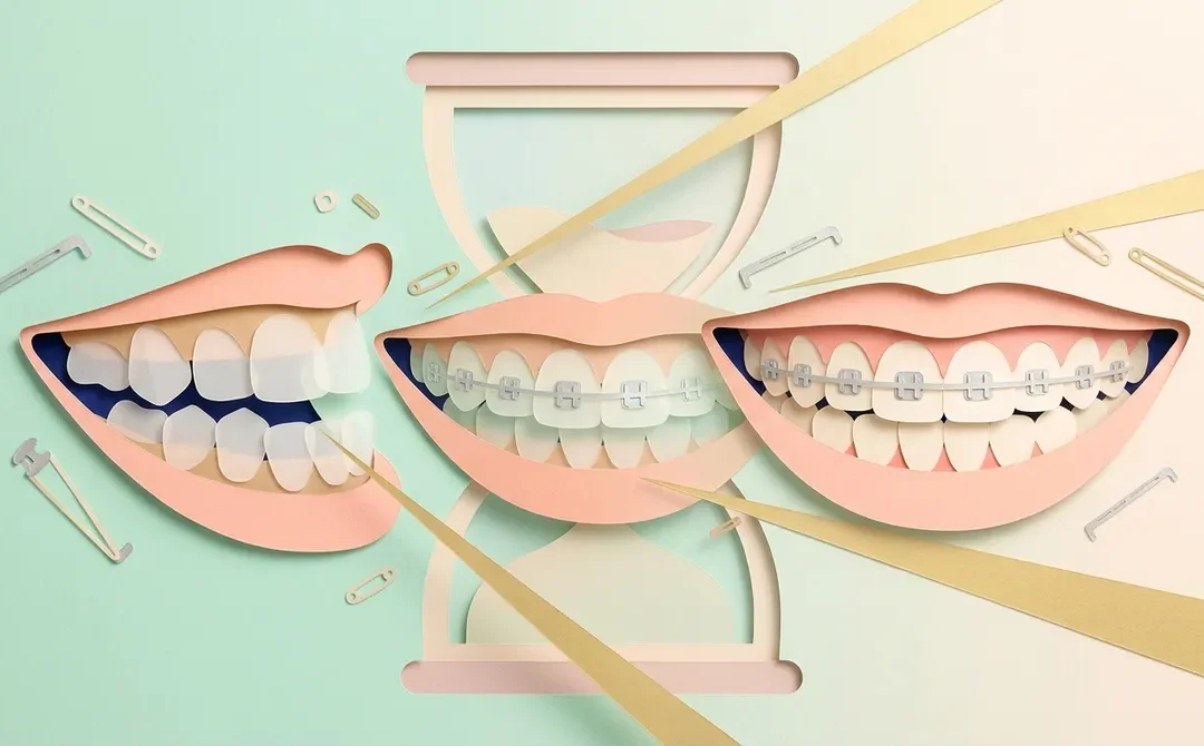 How Long Do Braces Take to Work?