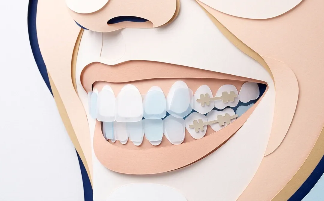 15 Less Visible Braces Options for a More Discreet Smile