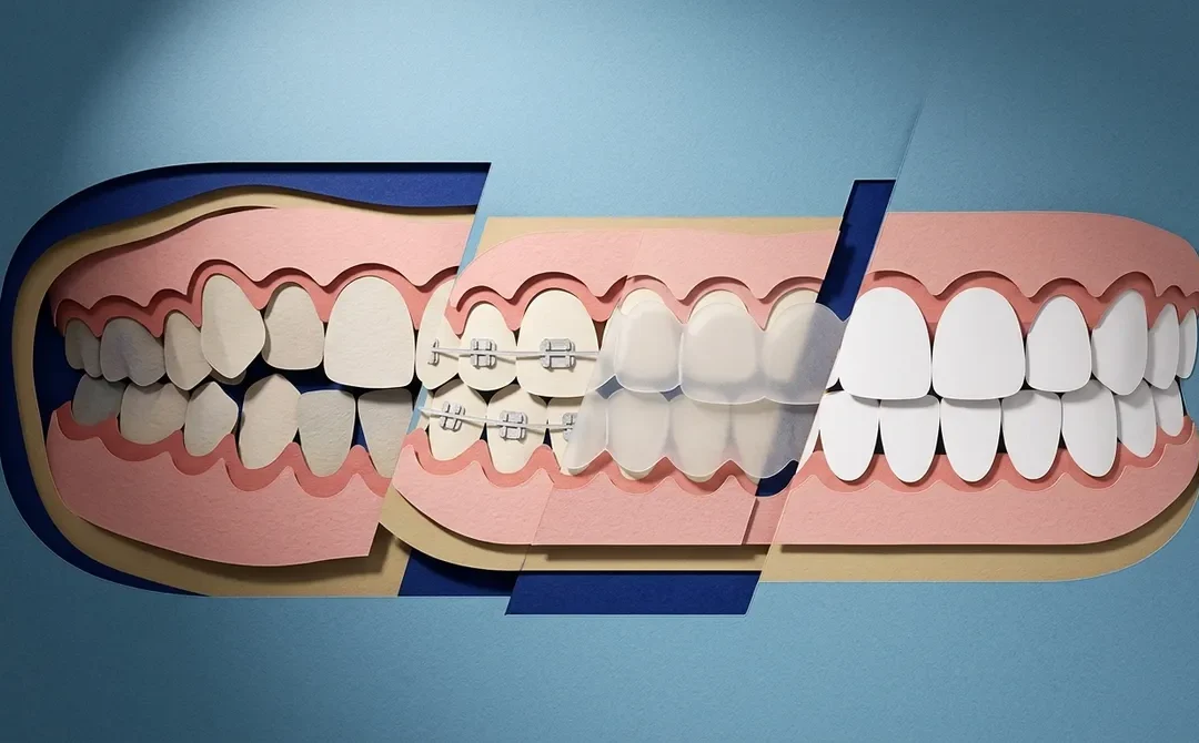 What Are the Best Crowded Teeth Treatment Options?