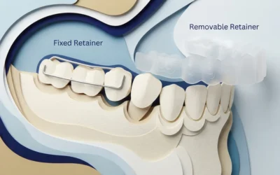 Fixed vs. Removable Bite Retainer: Which Wins?