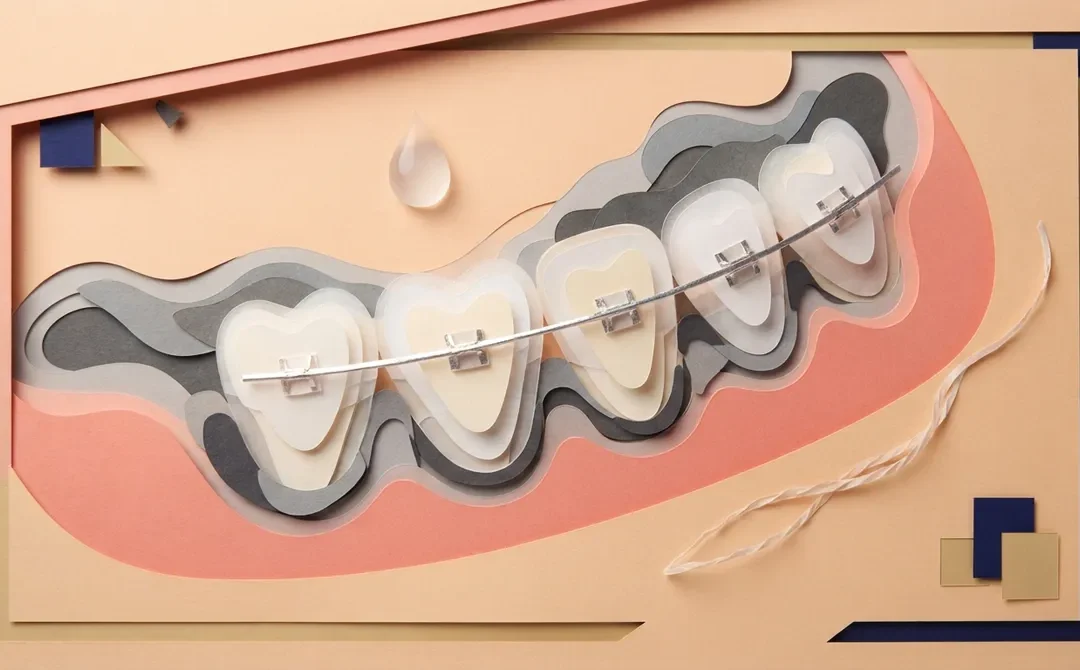Fixed Bonded Retainer: Keep Your Smile Straight for Life