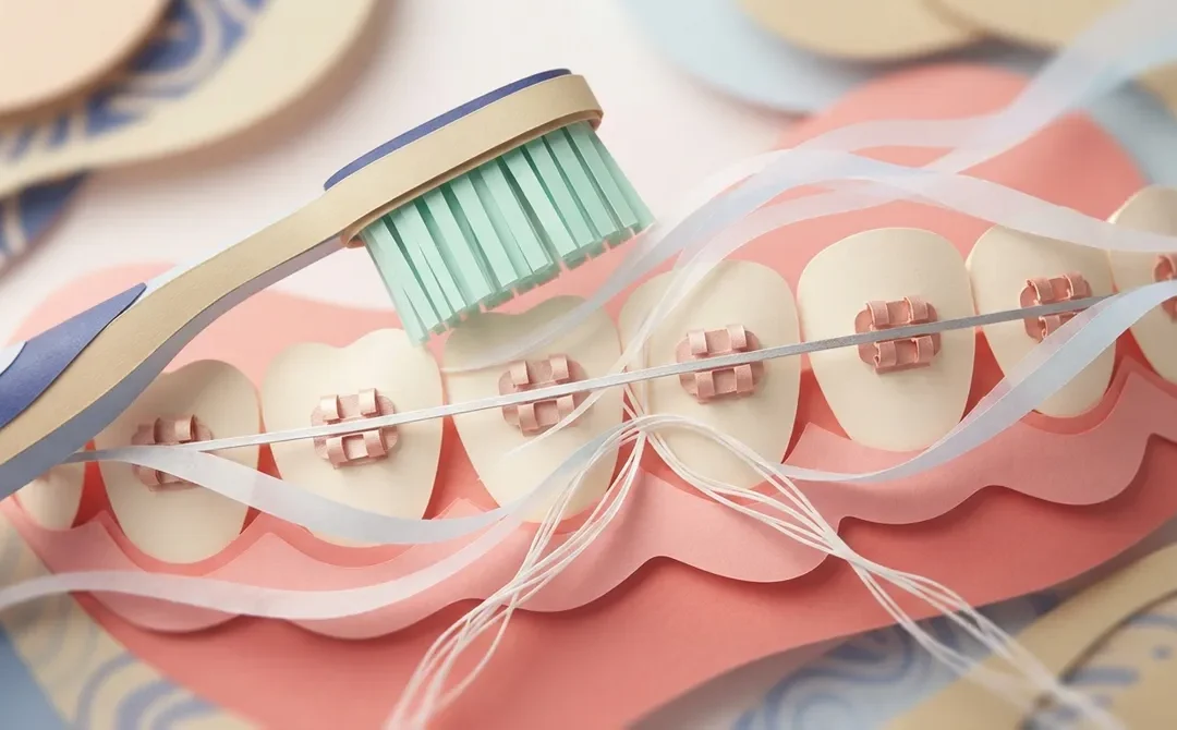 7 Brushing Mistakes That Wreck Braces (Fix Them Now)