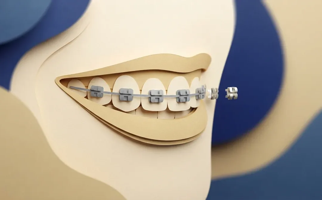 Rhodium Braces: A Discreet Metal Braces Option