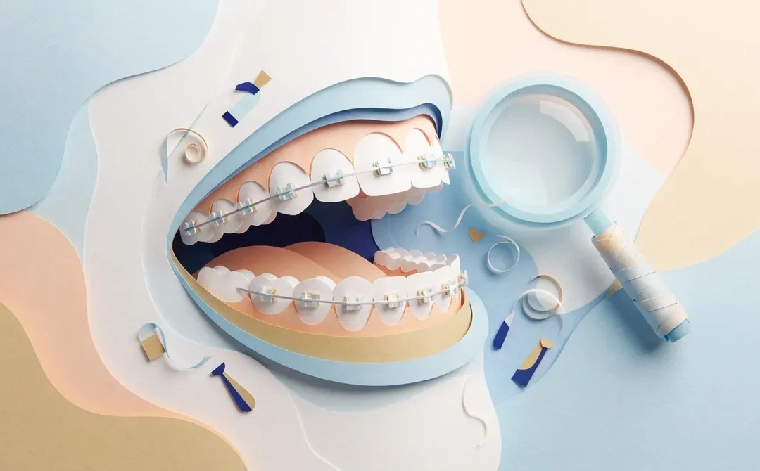 Incognito Braces: The Discreet Way to Straighten Teeth
