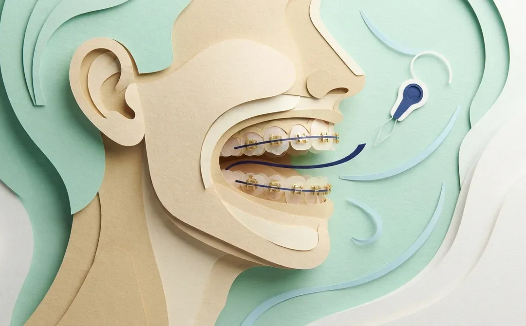 7 Lingual Braces Facts Clearwater Patients Should Know
