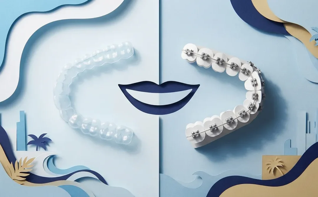 Clear Aligners vs. Braces in Clearwater: Which One Wins?