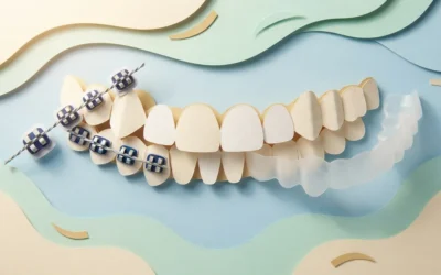 4 Ways to Choose Braces or Aligners for Crowded Teeth